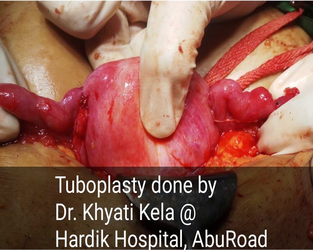 tuboplasty