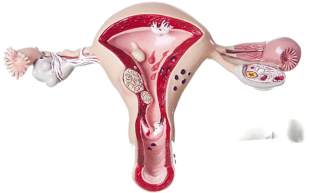 बच्चों और किशोरियों में फाइब्रॉएड: कारण, लक्षण और उपचार