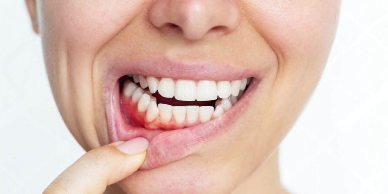 मसूड़ों से खून आना (Bleeding Gums): कारण, लक्षण, इलाज और बचाव